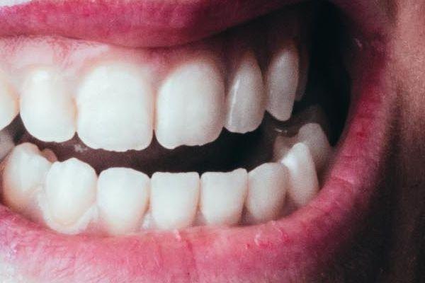 Zahnschienen